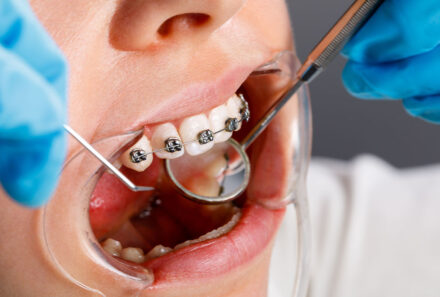 Unveiling the Advantages of Orthodontic Treatment in Mernda