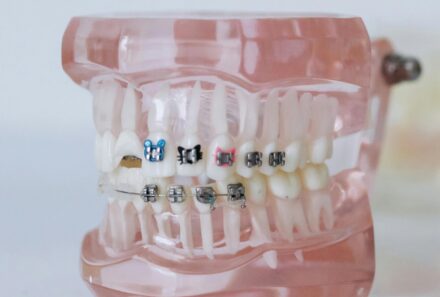 Braces Mistakes to Avoid: What Every Patient Should Know