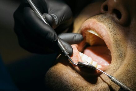 Removing Dental Plaque: A Comprehensive Guide by Universal Smiles Dental