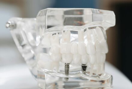 Dental Implants for Elderly: A Transformative Smile Solution