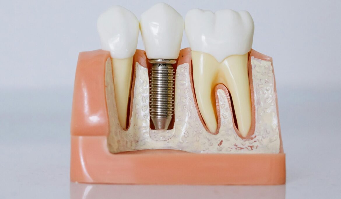 Finance dental implant treatment: Making a healthy smile affordable at Universal Smiled Dental