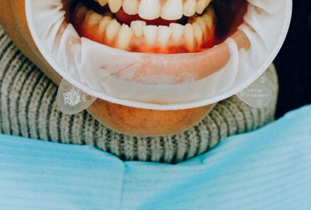 Oral Cancer Symptoms: Early Danger Signs You Should Never Ignore