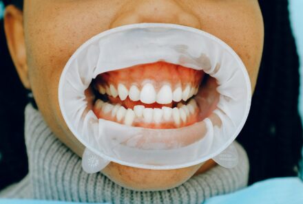 Relationship between Diet and Oral Health: What You Eat Affects Your Smile