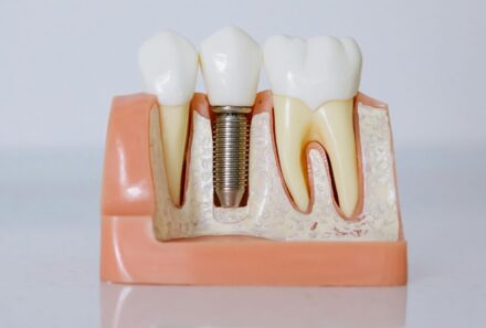 Are Implants Painful? Understanding the Truth Behind Dental Implant Treatment