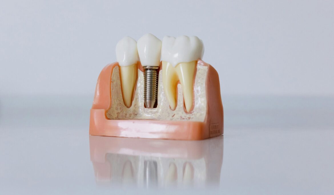 Risks and Benefits of Dental Implants: Things Every Patient Should Know