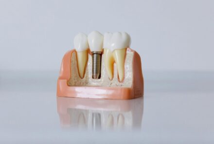 Risks and Benefits of Dental Implants: Things Every Patient Should Know