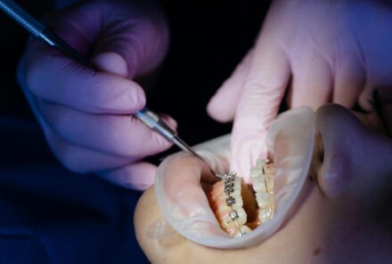 Is Teeth Straightening Painful? An Effective Guide by Universal Smiles Dental