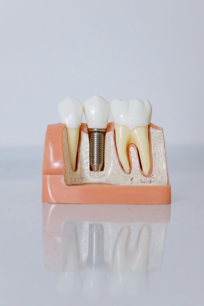 smoking and dental implants