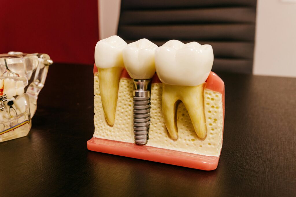 why implants feel and function better