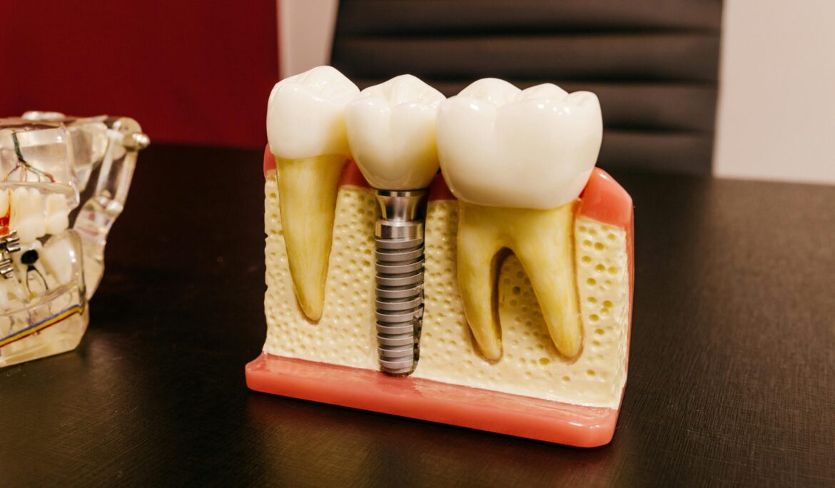 Why Implants Feel and Function Better
