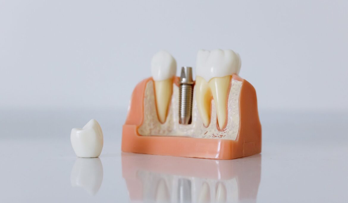 Dental Care and Implants: An Effective Guide to Maintaining Your Smile
