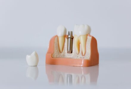 Dental Care and Implants: An Effective Guide to Maintaining Your Smile