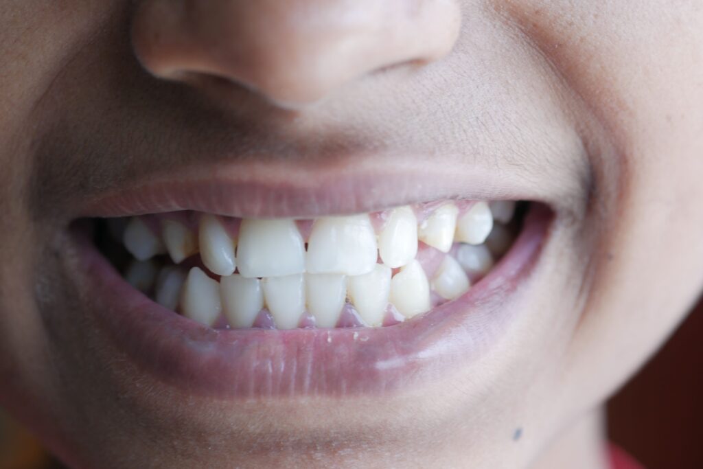 Grinding teeth at night