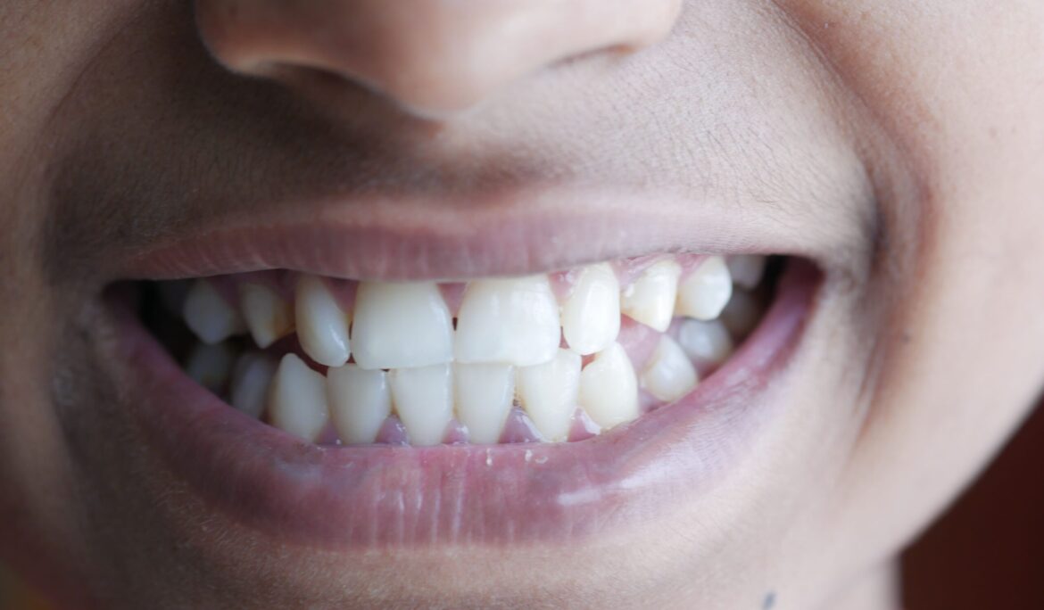 Grinding Teeth at Night: Causes, Effects, and Dental Care